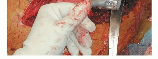 صورة طبية: إنقاذ الأطراف: أحدث التطورات في استبدال الجزء العلوي من عظم الفخذ