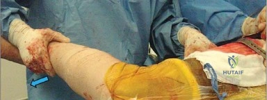 صورة طبية: إتقان توازن الأنسجة الرخوة لمفصل ورك صناعي مثالي: دليل شامل للمرضى مع الأستاذ الدكتور محمد هطيف