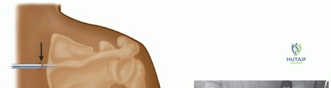 صورة طبية: متلازمة لوح الكتف الطقطقة الأسباب الأعراض والعلاج مع الأستاذ الدكتور محمد هطيف
