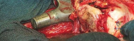 صورة طبية: جراحة استبدال مفصل الورك الملتهب في مرحلة واحدة: حل فعال وشامل مع الأستاذ الدكتور محمد هطيف