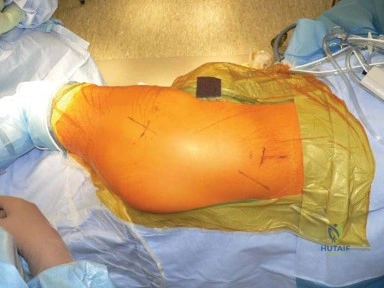 صورة طبية: استبدال مفصل الورك الكلي في العيادات الخارجية: دليل شامل من الأستاذ الدكتور محمد هطيف في صنعاء
