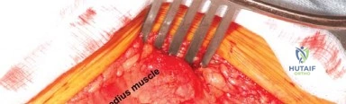 صورة توضيحية لـ مدخل هاردينج المعدل لجراحة الورك: دليل شامل لاستبدال مفصل الورك في صنعاء