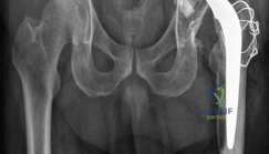 صورة شعاعية أمامية خلفية للحوض توضح مفصل ورك صناعي مثبت بالأسمنت مع انحراف رأس عظم الفخذ داخل البطانة البولي إيثيلين.