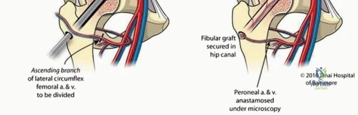 Illustration 12 for Head-Sparing for Osteonecrosis of the Femoral: Preserve Your Hip