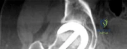 Illustration of case title hemiresurfacing - Dr. Mohammed Hutaif