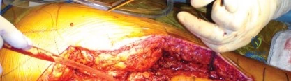 صورة توضيحية لـ استبدال مفصل الورك لإنقاذ حالات فشل تثبيت كسور الورك: حل فعال لاستعادة الحركة