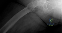 صورة توضيحية لـ جراحة استبدال مفصل الورك بالمدخل الأمامي المباشر بدون طاولة شد: دليل شامل للمرضى في صنعاء