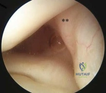 OITE & ABOS Orthopedic Board Prep: Practice Exam Part 100