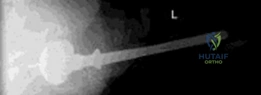 Proximal Humerus Fractures: Epidemiology, Etiology, Diagnosis, and Treatment