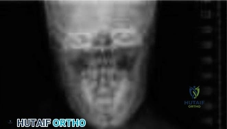 صورة لعمود فقري يوضح انحناء الجنف