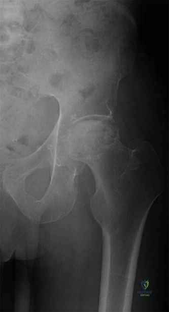 صورة توضيحية لـ النخر اللاوعائي المتقدم لرأس الفخذ: دليل شامل للعلاج واستبدال مفصل الورك مع الأستاذ الدكتور محمد هطيف في صنعاء