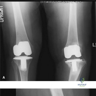 Illustration of painful tkr painful - Dr. Mohammed Hutaif
