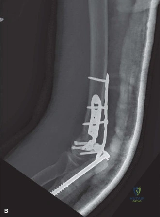Illustration of distal humerus fractures distal - Dr. Mohammed Hutaif