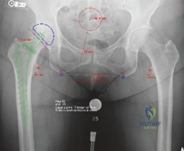 صورة بالأشعة السينية الأمامية الخلفية قبل الجراحة مع قالب تخطيطي يوضح التخطيط المسبق لمكونات المفصل الصناعي