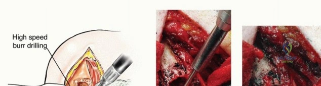 صورة طبية: جراحة نقائل عظم العضد: دليل شامل لاستعادة الوظيفة وتخفيف الألم في اليمن مع الأستاذ الدكتور محمد هطيف