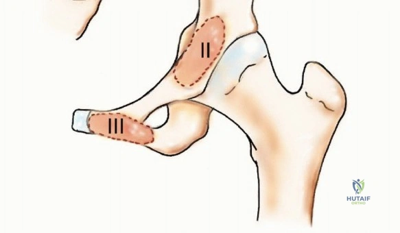 صورة توضيحية لـ شلل العصب الزندي: دليل شامل للمرضى حول الأسباب، الأعراض، وطرق العلاج المتطورة في اليمن والخليج
