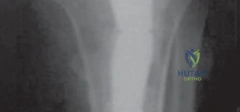 صورة توضيحية لـ جذوع الركبة غير المثبتة بالأسمنت في جراحات المراجعة: دليل شامل للمرضى مع الأستاذ الدكتور محمد هطيف