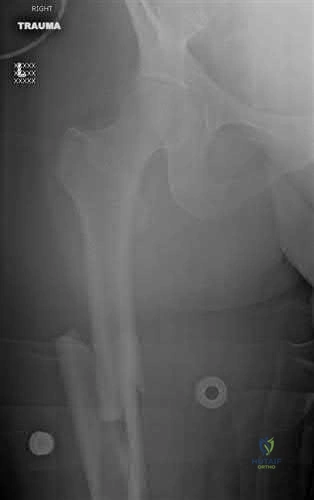صورة طبية: دليل شامل لكسور وإصابات الجهاز الحركي: رعاية متقدمة في صنعاء مع الأستاذ الدكتور محمد هطيف