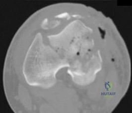 Skeletal Dysplasias of the Spine - Arab Board MCQ Prep
