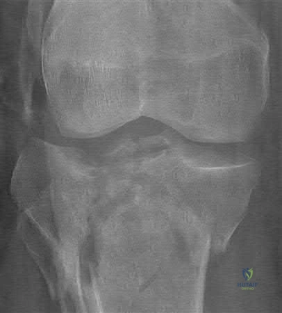 صورة طبية: دليل شامل لكسور وإصابات الجهاز الحركي: رعاية متقدمة في صنعاء مع الأستاذ الدكتور محمد هطيف