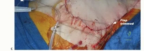 صورة توضيحية لـ بتر الربع الأمامي: كل ما يجب أن تعرفه عن هذا الإجراء المعقد