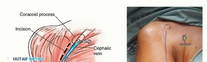 صورة توضيحية لـ جراحة نقائل عظم العضد: دليل شامل لاستعادة الوظيفة وتخفيف الألم في اليمن مع الأستاذ الدكتور محمد هطيف