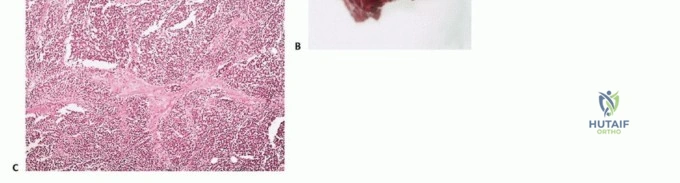 صورة طبية: أورام العظام والأنسجة الرخوة: دليلك الشامل للفهم والعلاج مع الأستاذ الدكتور محمد هطيف