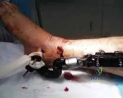 تفاصيل مرئية 8 - التثبيت الخارجي للقصبة: هكذا يتم وضع مسمارين لكسور معقدة