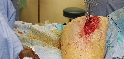 صورة طبية: النهج الخلفي لمفصل الورك: دليل شامل لاستعادة الحركة في صنعاء مع الأستاذ الدكتور محمد هطيف