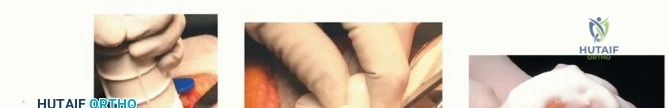 صورة طبية: جراحة استبدال مفصل الركبة الكلي بالأسمنت: حل دائم لتخفيف الألم واستعادة الحركة مع الأستاذ الدكتور محمد هطيف في صنعاء