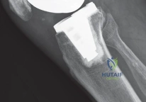 صورة طبية: استبدال مفصل الركبة بالحد الأدنى من التدخل الجراحي: ألم أقل وتعافٍ أسرع مع النهج شبه الرضفي الإنسي