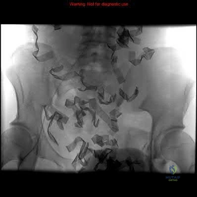 صورة طبية: دليل شامل لكسور وإصابات الجهاز الحركي: رعاية متقدمة في صنعاء مع الأستاذ الدكتور محمد هطيف