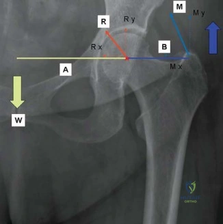 صورة توضيحية لـ إتقان توازن الأنسجة الرخوة لمفصل ورك صناعي مثالي: دليل شامل للمرضى مع الأستاذ الدكتور محمد هطيف