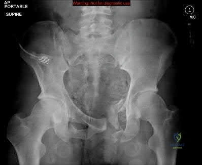 صورة طبية: دليل شامل لكسور وإصابات الجهاز الحركي: رعاية متقدمة في صنعاء مع الأستاذ الدكتور محمد هطيف
