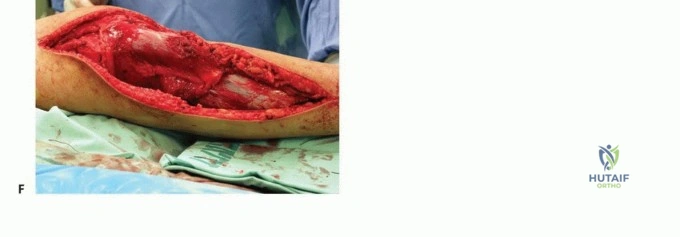 صورة توضيحية لـ معالجة الأورام المعقدة في قصبة الساق القريبة حلول الحفاظ على الأطراف