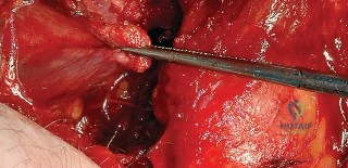صورة توضيحية لـ النهج الخلفي لمفصل الورك: دليل شامل لاستعادة الحركة في صنعاء مع الأستاذ الدكتور محمد هطيف