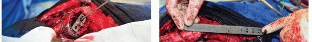 صورة طبية: مراجعة مفصل الورك بالإسمنت داخل الإسمنت: حلول متقدمة لعمليات استبدال الورك المعقدة مع الأستاذ الدكتور محمد هطيف