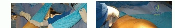 صورة MRI لمفصل الورك