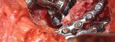 صورة توضيحية لـ إدارة كسور الحوض حول المفصل الصناعي: دليل جراحي شامل للمرضى بقلم الأستاذ الدكتور محمد هطيف