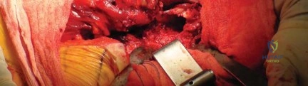 صورة طبية: استبدال مفصل الورك لإنقاذ حالات فشل تثبيت كسور الورك: حل فعال لاستعادة الحركة