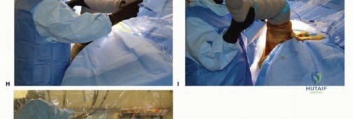 صورة طبية: تخفيف الانحشار الفخذي الحقي الأمامي: نهج الجراحة المفتوحة المصغرة مع الأستاذ الدكتور محمد هطيف