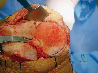 صورة طبية: جراحة استبدال مفصل الركبة التقوسي: الحل النهائي لآلام الركبة في صنعاء | الأستاذ الدكتور محمد هطيف