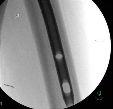 صورة طبية: دليل شامل لكسور وإصابات الجهاز الحركي: رعاية متقدمة في صنعاء مع الأستاذ الدكتور محمد هطيف