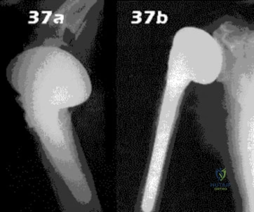 صورة توضيحية لـ تغلّب على شلل العصب الكعبري: دليل شامل لعمليات نقل الأوتار والعلاج في اليمن