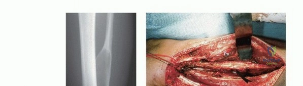 صورة طبية: استئصال أورام الشظية: دليل شامل للعلاج الحديث والحفاظ على الأطراف مع الأستاذ الدكتور محمد هطيف