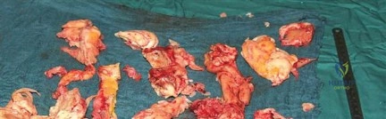 صورة طبية: جراحة استبدال مفصل الورك الملتهب في مرحلة واحدة: حل فعال وشامل مع الأستاذ الدكتور محمد هطيف