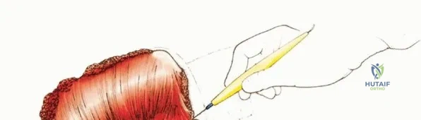 بدء جلسات العلاج الطبيعي بعد الجراحة