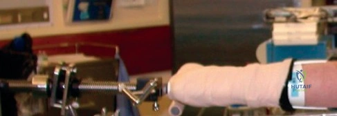 صورة طبية: منظار مفصل الفخذ: حل متقدم لآلام الورك ومشاكله المعقدة في صنعاء