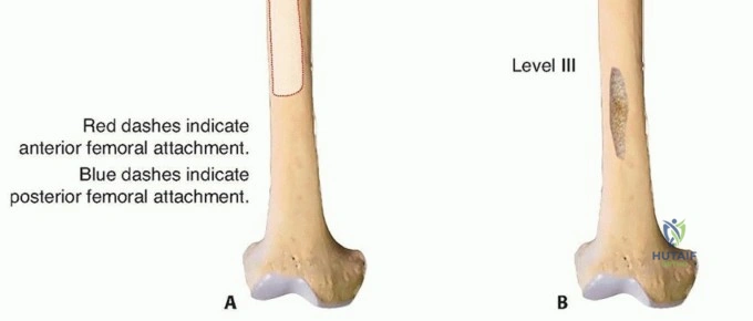صورة لتصوير تشخيصي لمفصل الفخذ (CT scan)