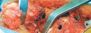 صورة توضيحية لـ جراحة استبدال المفاصل بدون أسمنت: دليل شامل للمرضى مع الأستاذ الدكتور محمد هطيف في صنعاء
